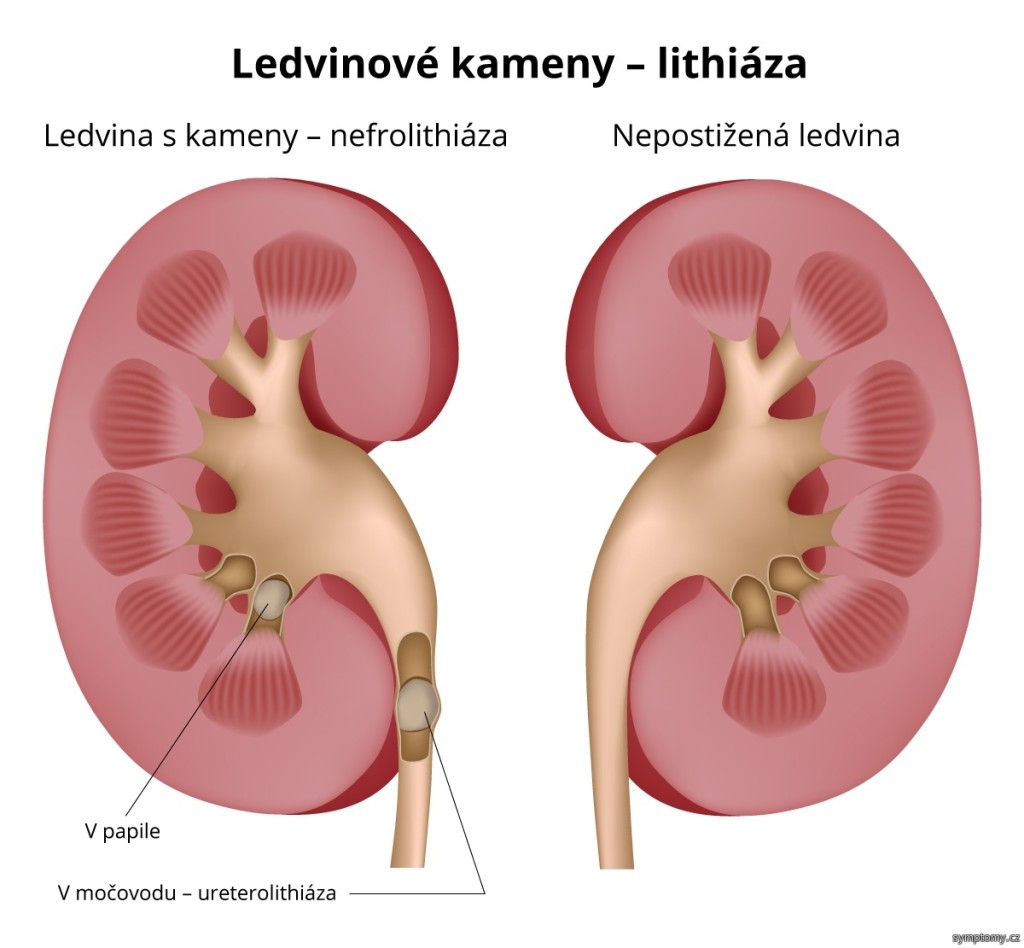 ledvinove-kameny-lithiaza